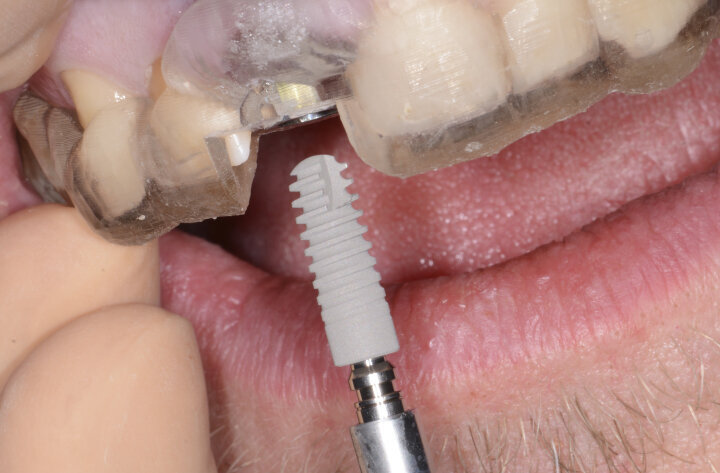 Fig. 15: Placement of the Ankylos implant using the Simplant Guide.