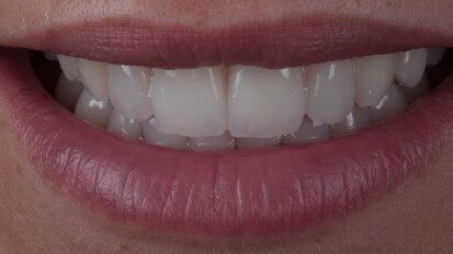 Surface texture: Using horizontal and vertical lines to simulate natural tooth appearance—Theory and technical procedure of lines