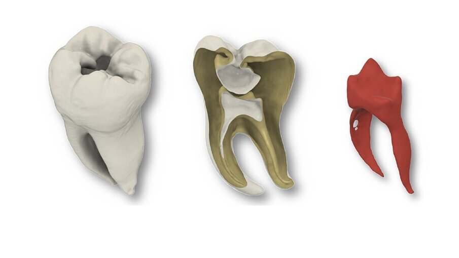 3D-printed teeth improve endodontic training_3
