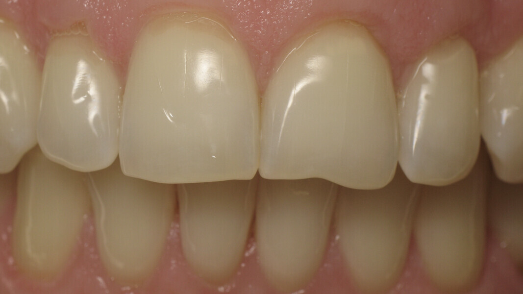 Fig. 2 : Photographie des dents antérieures de la petite-fille de la patiente.