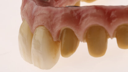 Full-arch rehabilitation with lithium disilicate secondary crowns luted on to the primary framework