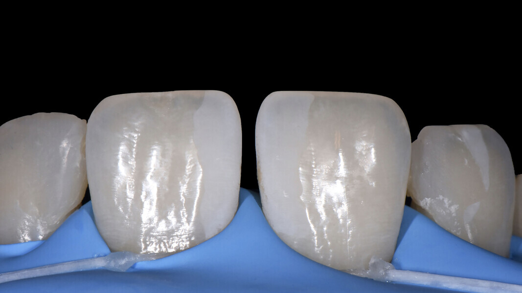Fig. 6: Situation after suction of the etching gel, rinsing and careful drying of the conditioned surfaces.