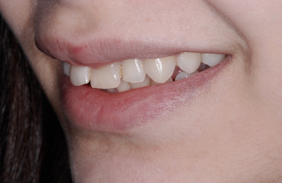 Fig. 21: Smile left side view before treatment.