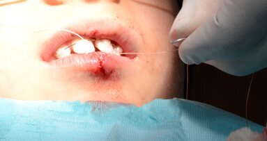 Avulsion in Paediatric Dentistry: Management  of a Double Dental Emergency in a Child