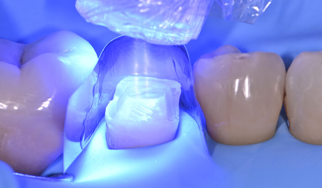 Fig. 5: Immediate dentinal sealing: light polymerisation of the adhesive layer. 