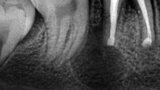 Figura 6. Control al mes, donde se evidencia inicio de cicatrización y reparación de la reabsorción radicular externa.
