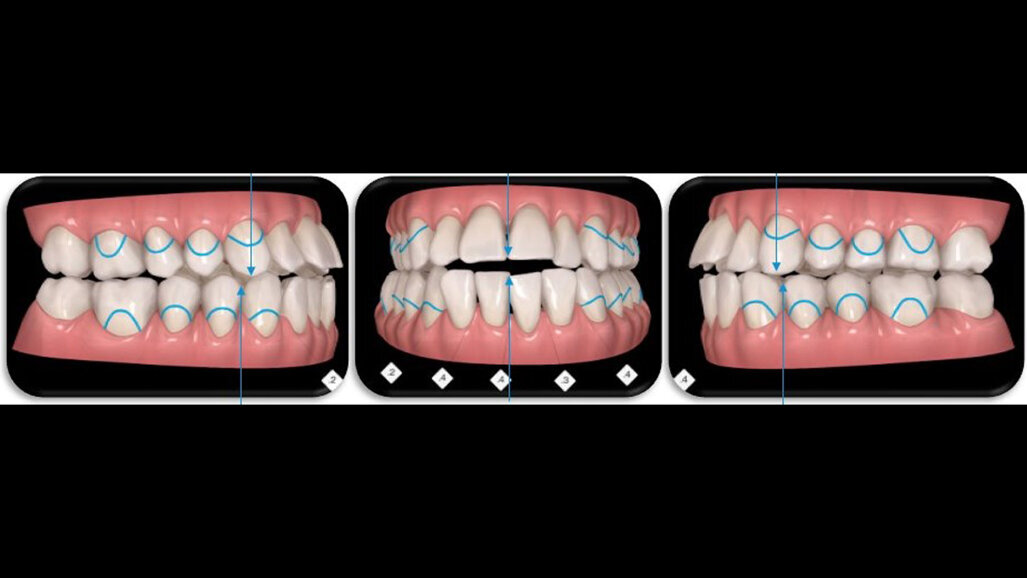 Allineatori trasparenti in tecnica Invisalign, Surgery First in caso di recidiva di iperplasia condilare