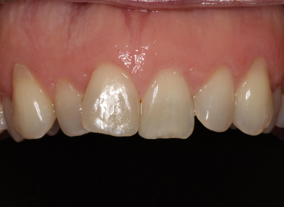 Pre-treatment