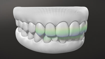 Invisalign G8, systém s novými aktivačními funkcemi SmartForce Aligner Activation