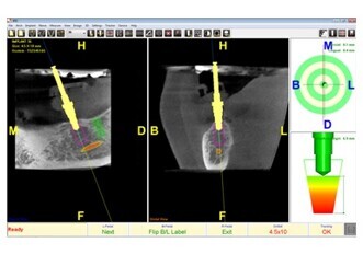Implant Realtime Imaging System (IRIS-100)