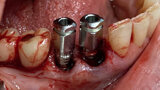 Figs. 9. Colocación de 2 implantes post-extracción en posiciones del 43 y 44 y control radiográfico post-extracción.