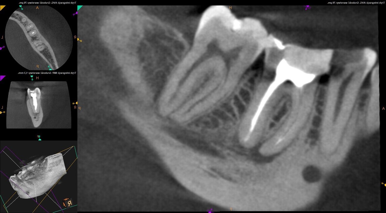 Fig. 12: Pre-op CBCT scan. Periapical lesion visible.