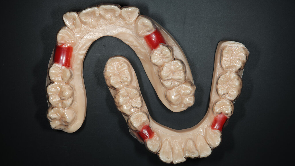 In-house 3D-printing workflows for implant restorations and Shape Memory Aligners