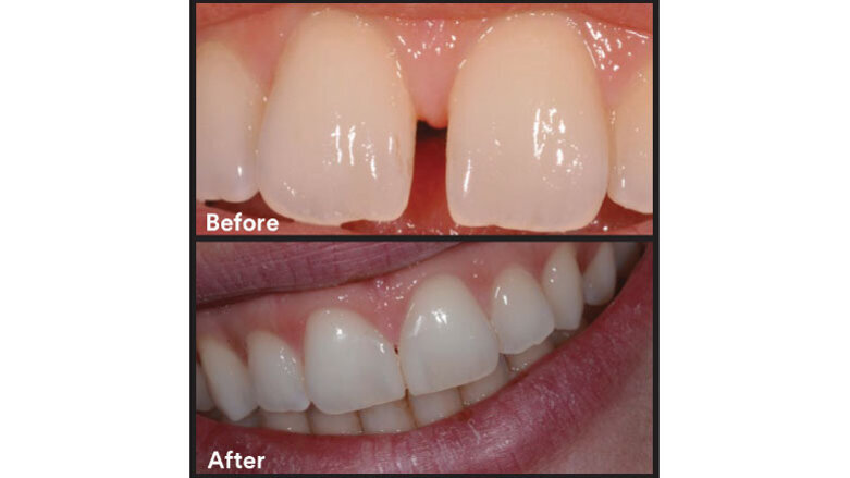 Midline diastema closure using  the front wing technique