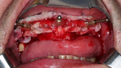 Compromised maxillary dentition treated with Straumann Pro Arch and a digital workflow
