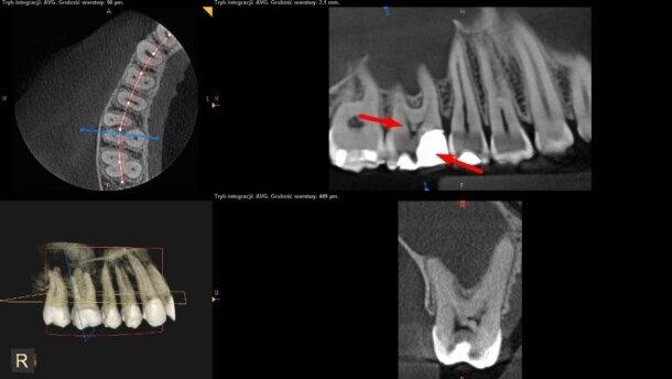 Wykorzystanie CBCT w pierwotnym leczeniu kanałowym zęba z zębiniakiem