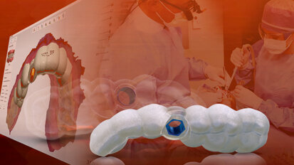 Glidewell now offering digital treatment planning to implant dentists