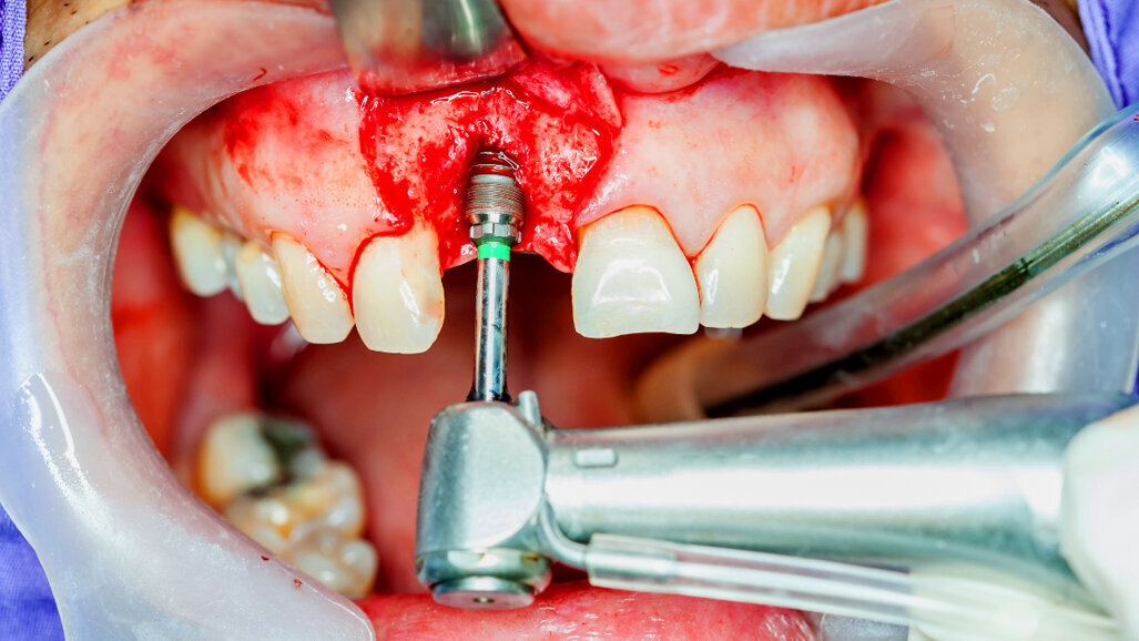 National standards for implant dentistry announced
