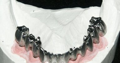 Semplicità realizzativa di una struttura complessa “Toronto” attraverso l’utilizzo di SUM3D Dental