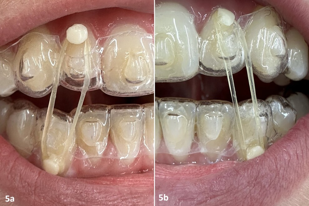 Figs. 5a & b: Adjustment of the traction of the maxillary lateral incisors and mandibular canines and repositioning using bonded buttons and windows opened in the aligners for the use of vertical elastics, allowing the teeth to recover their position within the aligner slot and enabling continuation with the subsequent aligners with proper aligner fit.