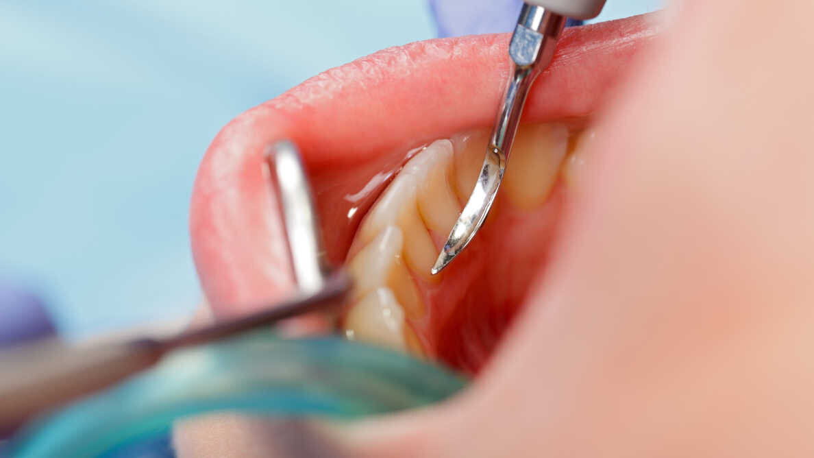 O estudo oferece novos conhecimentos sobre o desenvolvimento e prevenção da cárie dentária