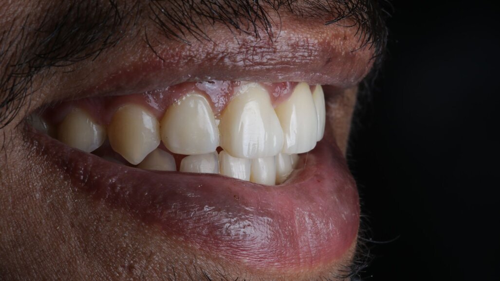 Ortho-Resto Continuum —An Interdisciplinary Approach: Case Report