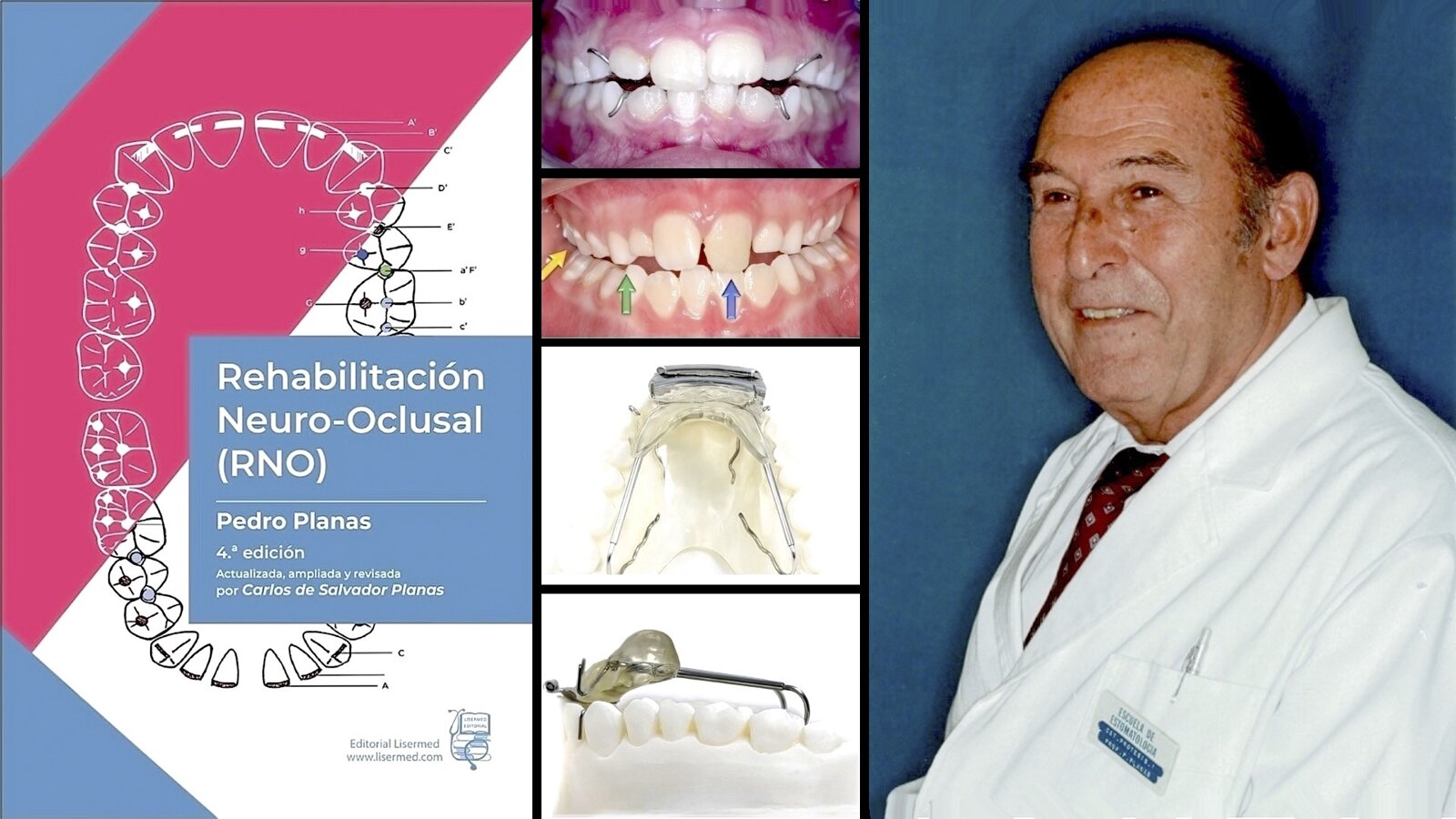 Por una actualización de la Rehabilitación Neurooclusal de Pedro Planas