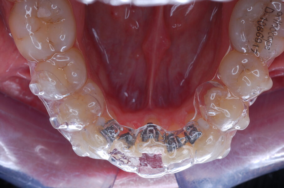 Fig. 33_Allineatore con canali di movimento incorporati nel design per consentire ai denti di muoversi anche quando l’allineatore viene posizionato sopra di essi. I denti utilizzati come ancoraggio non presentano spazi, in modo che l’allineatore si adatti perfettamente ad essi.