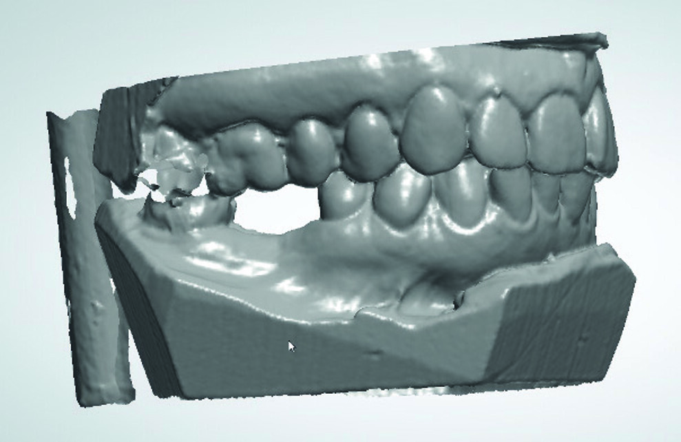 Fig. 3 : Image du scannage des empreintes au plâtre. 