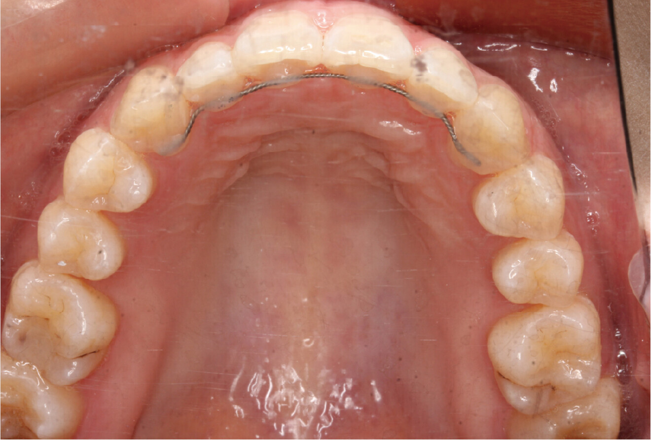Fig. 4e: Occlusal intra-oral view of the maxilla. 