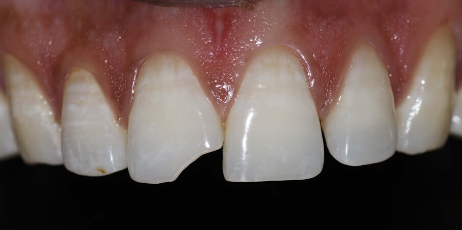 Fig 2: Pre op Intraoral