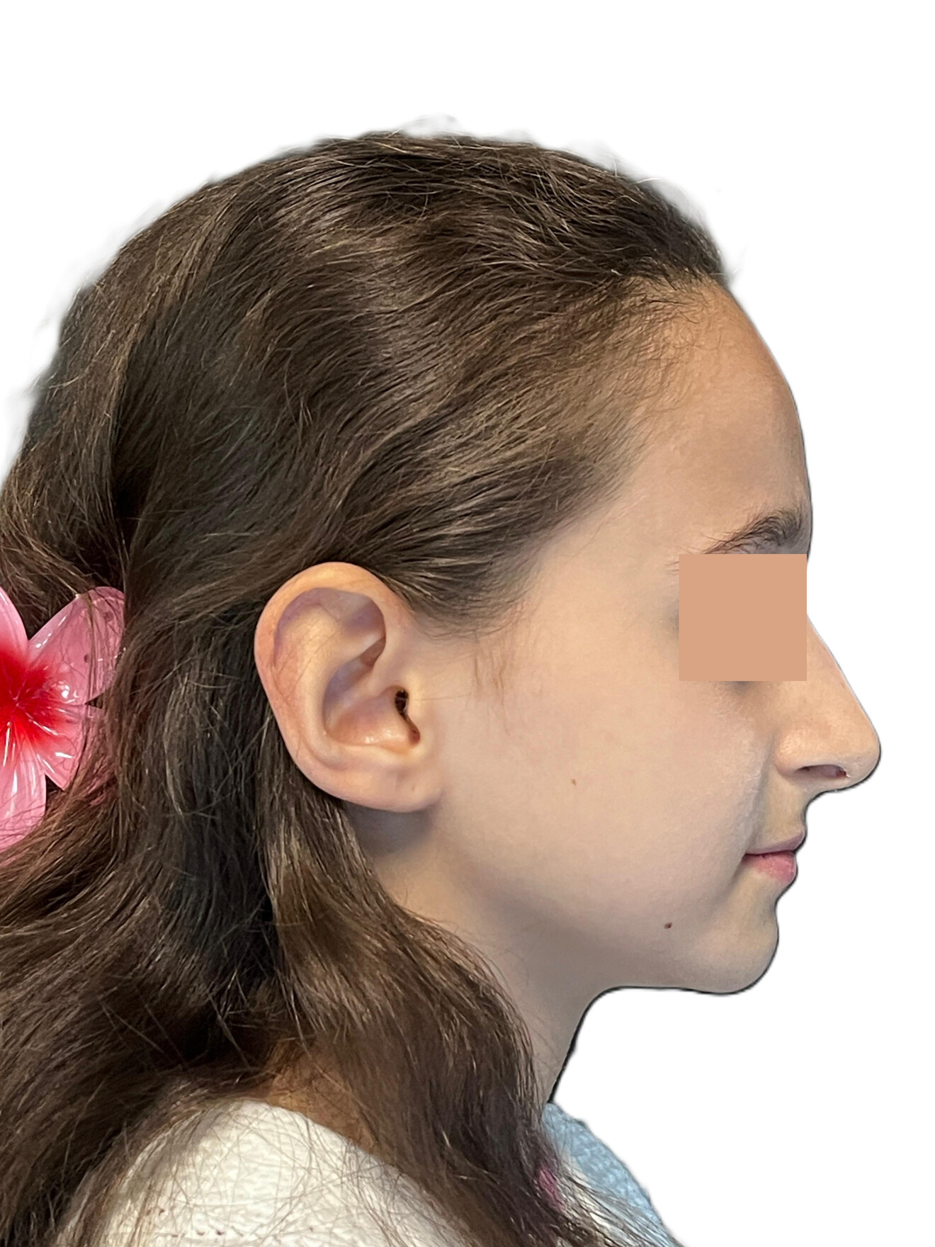 Figs. 2a–c: Post-treatment records. Extra-oral photographs. 
