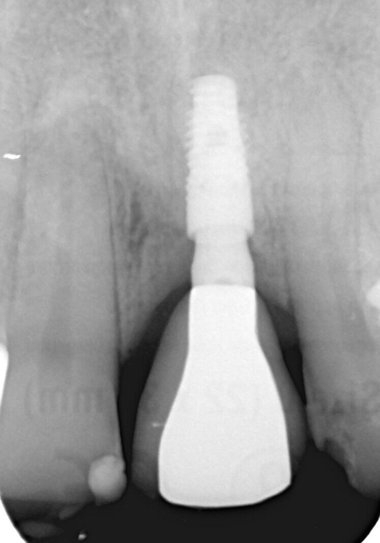 Fig. 15_Rx.Stabilità dei tessuti duri perimplantari dopo 4 anni.