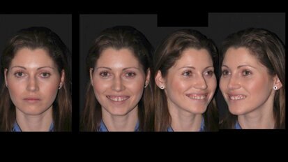 El embellecimiento de sonrisas con ácido hialurónico