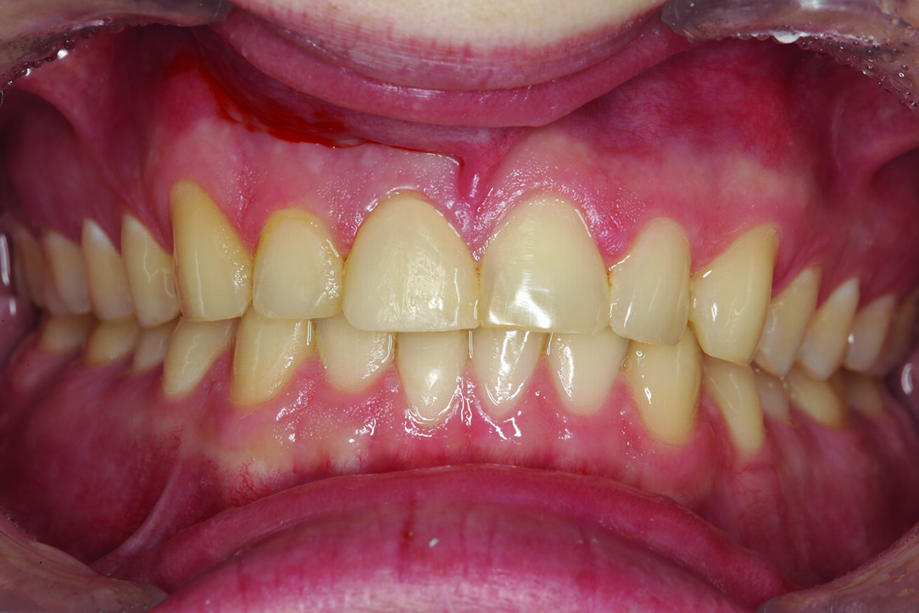 Fig. 14: Retracted facial view of tooth #11 after provisionalisation with the teeth in maximum intercuspation.