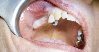 Screw-retained restoration of a maxillary first molar and second premolar