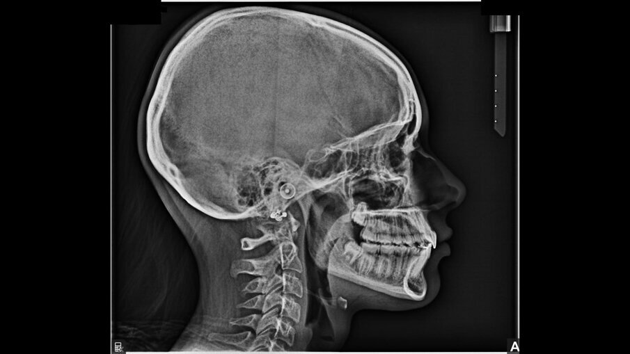 Fig. 25_Teleradiografia post-trattamento.
