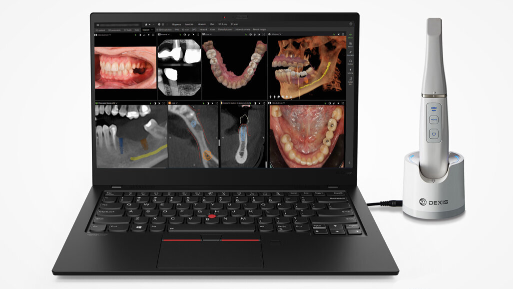 DEXIS Intraoralscanner jetzt mit offener und KI-unterstützter Bildgebungssoftware