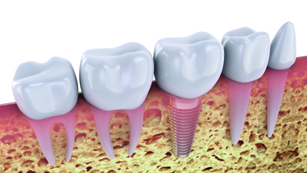 CBCT zones of the jaw - Bone quality related to implant location