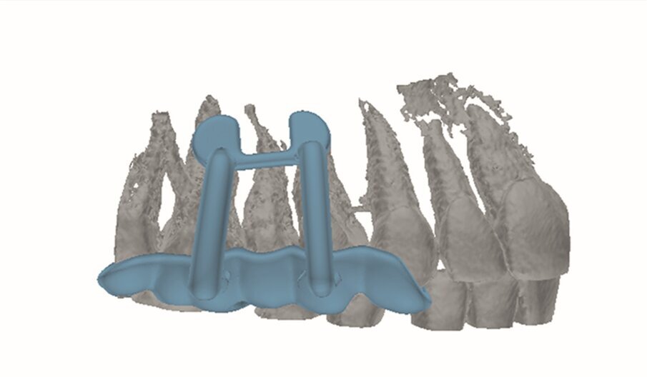 Fig. 2e: Planned template for guided endodontic microsurgery of tooth #15.