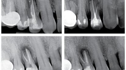 Když se příroda vysmívá endodontistům – dvě kazuistiky
