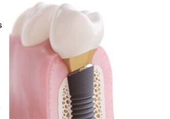 Solving clinical challenges with new treatment solution from DENTSPLY Implants