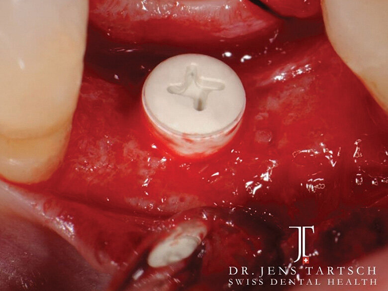 Fig. 6: The flat healing cap allows a primary wound closure, guided-surgery system. (Photo: Jens Tartsch, DMD)