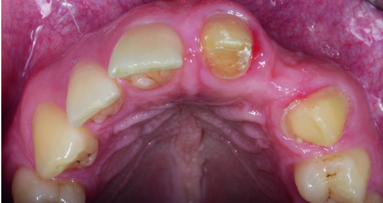 Reconstruction of a horizontal ridge defect using the bone lamina technique