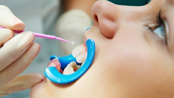 Relatório confirma eficácia dos selantes dentários contra cárie na infância