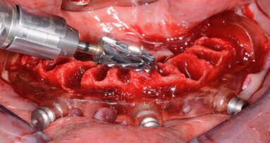 Overdenture solutions for today’s economy