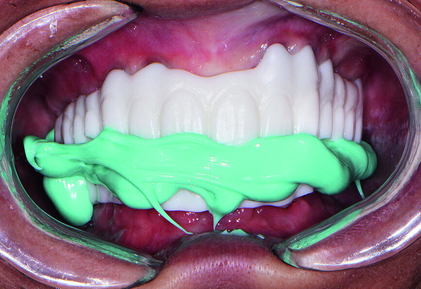 Fig 20 Composant du sourire en PMMA