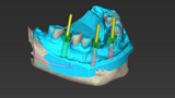 coDiagnostiX implant placement