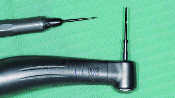 L’implant plutôt que le « dentier » : une réalité incontournable, mais une préparation et des précautions indispensables