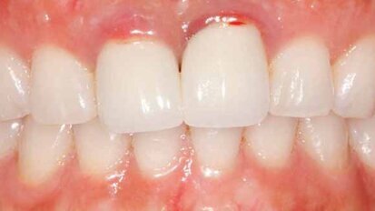 Solid zirconia restoration